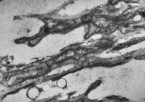 M,15y. | neurinoma - orbita M,15y. | neurinoma - orbita